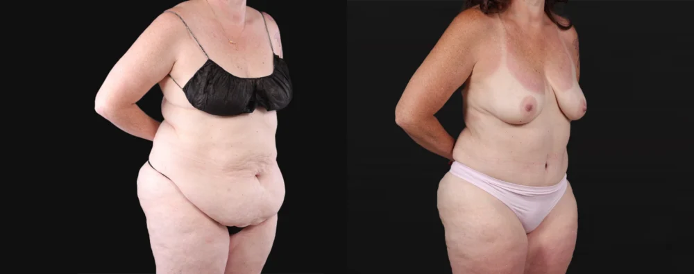 Post Bariatric Surgery (Massive Weight Loss) case #267139