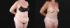 Post Bariatric Surgery (Massive Weight Loss) case #267139 slider thumbnail