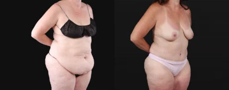 Post Bariatric Surgery (Massive Weight Loss) case #267139