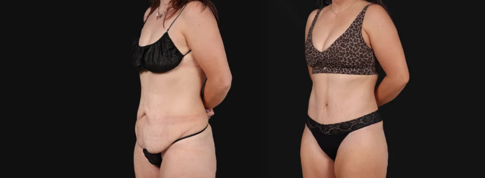 Tummy Tuck case #267116