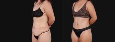Tummy Tuck case #267116