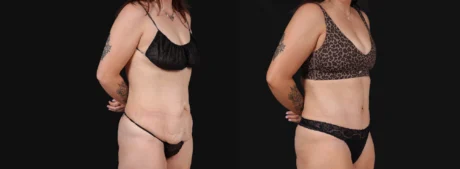 Tummy Tuck case #267116