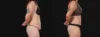 Tummy Tuck case #267116 slider thumbnail