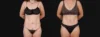 Tummy Tuck case #267116 slider thumbnail