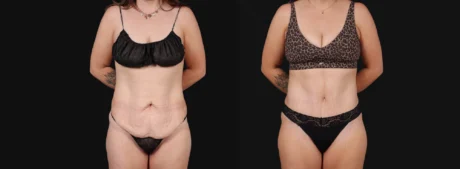 Tummy Tuck case #267116
