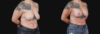 Breast Lift with Implants case #267182 slider thumbnail