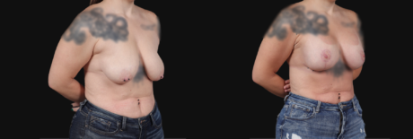 Breast Lift with Implants case #267182