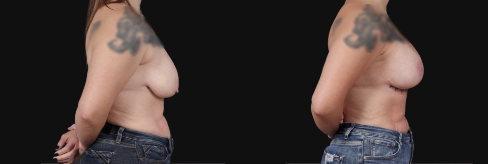 Breast Lift with Implants case #267182