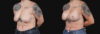Breast Lift with Implants case #267182 slider thumbnail