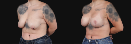 Breast Lift with Implants case #267182