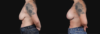 Breast Lift with Implants case #267182 slider thumbnail