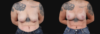 Breast Lift with Implants case #267182 slider thumbnail