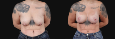 Breast Lift with Implants case #267182