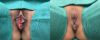 Labiaplasty case #267153 slider thumbnail