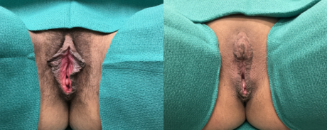 Labiaplasty case #267153