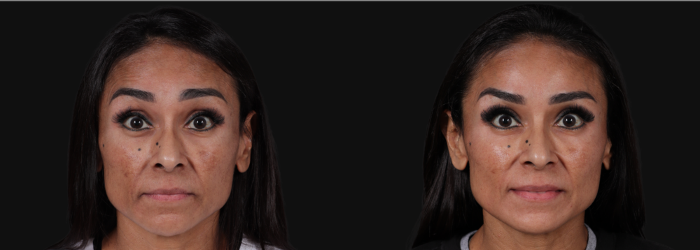 Botox® & Other Neuromodulators case #267167