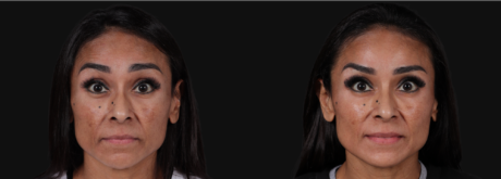 Botox® & Other Neuromodulators case #267167