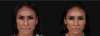 Botox® & Other Neuromodulators case #267167 slider thumbnail