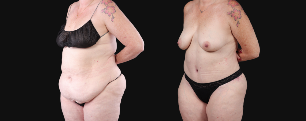 Post Bariatric Surgery (Massive Weight Loss) case #267139