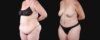 Post Bariatric Surgery (Massive Weight Loss) case #267139 slider thumbnail