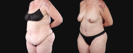 Post Bariatric Surgery (Massive Weight Loss) case #267139
