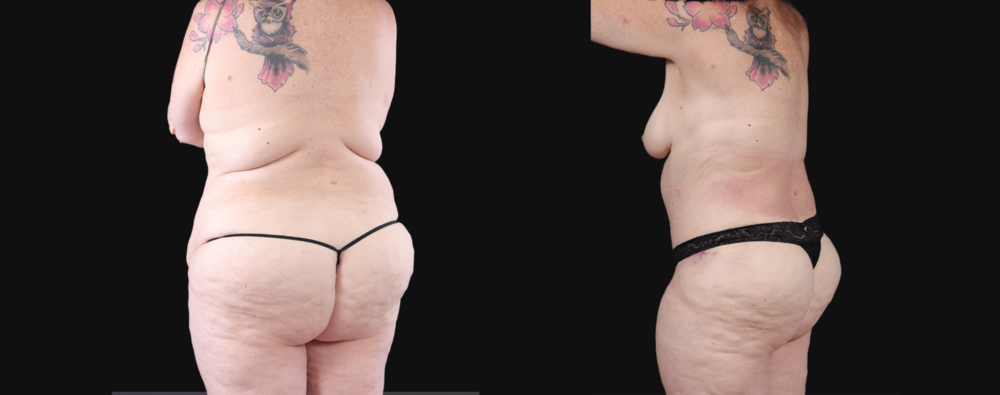 Post Bariatric Surgery (Massive Weight Loss) case #267139