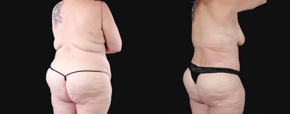 Post Bariatric Surgery (Massive Weight Loss) case #267139