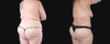 Post Bariatric Surgery (Massive Weight Loss) case #267139 slider thumbnail