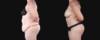 Post Bariatric Surgery (Massive Weight Loss) case #267139 slider thumbnail