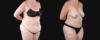 Post Bariatric Surgery (Massive Weight Loss) case #267139 slider thumbnail