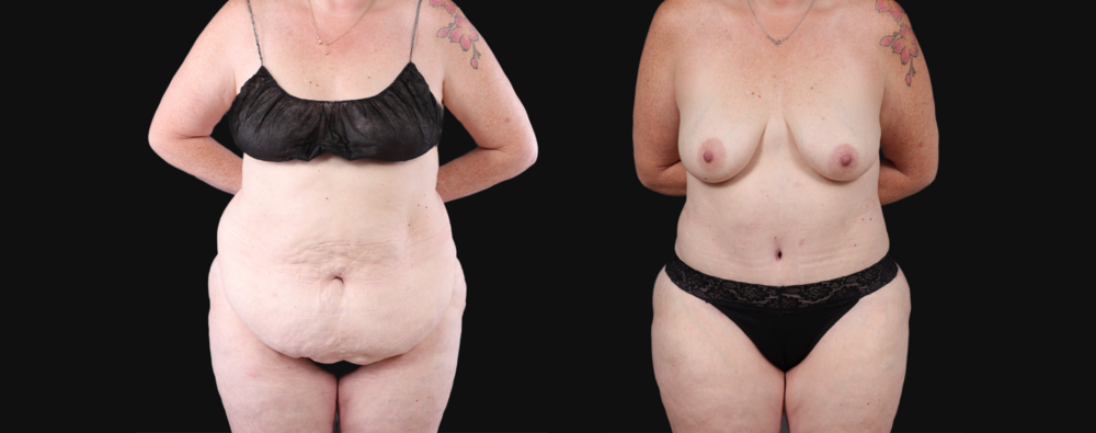 Post Bariatric Surgery (Massive Weight Loss) case #267139