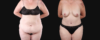 Post Bariatric Surgery (Massive Weight Loss) case #267139 slider thumbnail