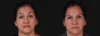 Botox® & Other Neuromodulators case #267363 slider thumbnail