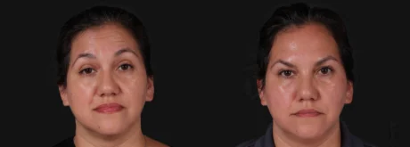 Botox® & Other Neuromodulators case #267363