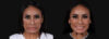 Botox® & Other Neuromodulators case #267167 slider thumbnail