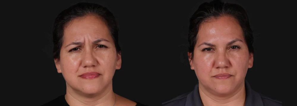 Botox® & Other Neuromodulators case #267363