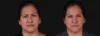 Botox® & Other Neuromodulators case #267363 slider thumbnail