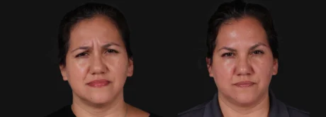 Botox® & Other Neuromodulators case #267363