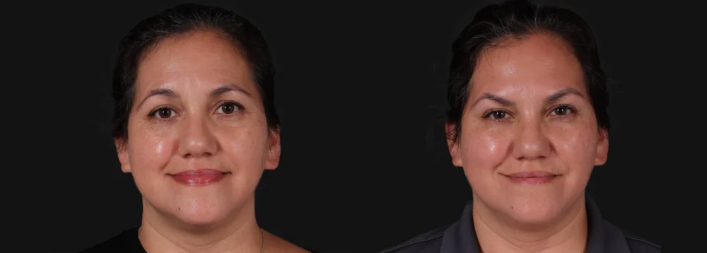 Botox® & Other Neuromodulators case #267363