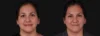Botox® & Other Neuromodulators case #267363 slider thumbnail