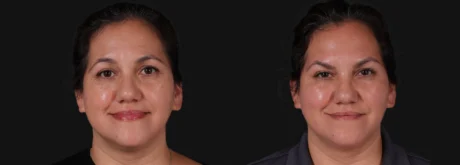 Botox® & Other Neuromodulators case #267363