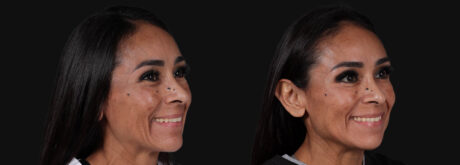 Botox® & Other Neuromodulators case #267167
