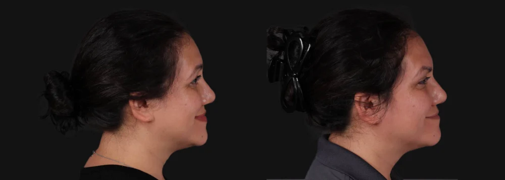 Botox® & Other Neuromodulators case #267363