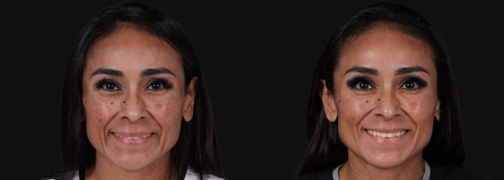 Botox® & Other Neuromodulators case #267167