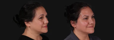 Botox® & Other Neuromodulators case #267363