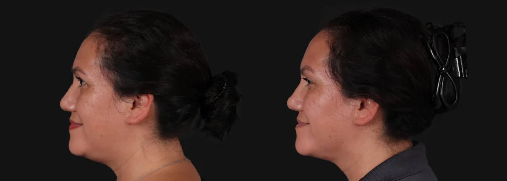 Botox® & Other Neuromodulators case #267363