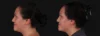 Botox® & Other Neuromodulators case #267363 slider thumbnail