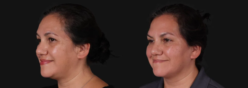 Botox® & Other Neuromodulators case #267363