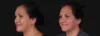 Botox® & Other Neuromodulators case #267363 slider thumbnail