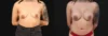 Breast Augmentation case #267157 slider thumbnail